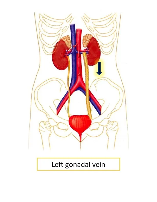 vena gonadal izquierda