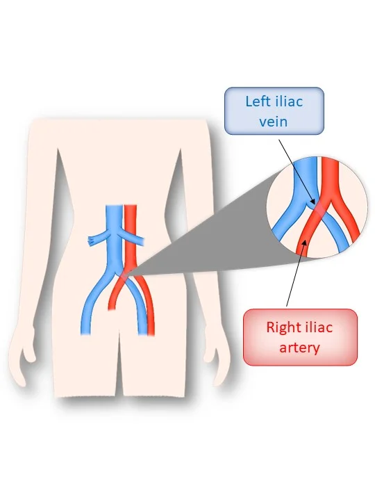 vena y arteria iliaca izquierda