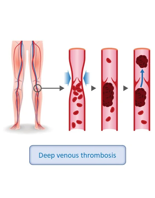trombosis venosa profunda