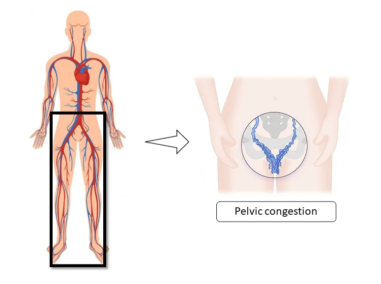 congestión pélvica